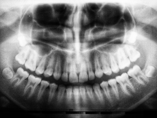 an x-ray of teeth